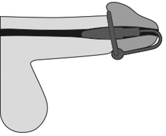 Ollonring och dilator